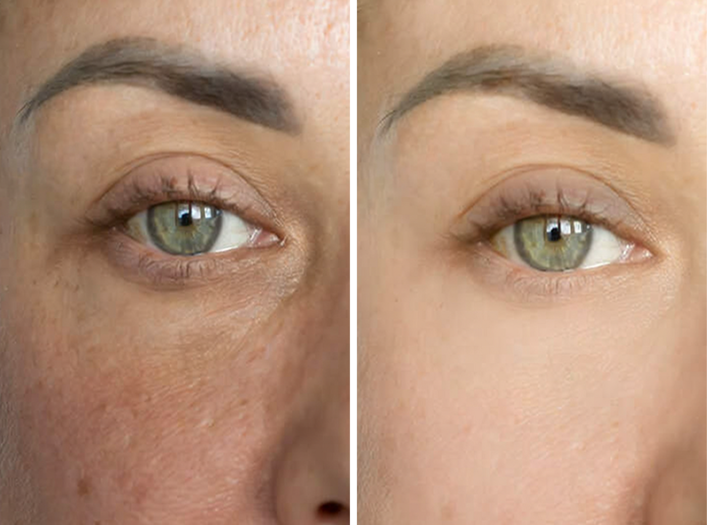 Accelerate collagen synthesis
