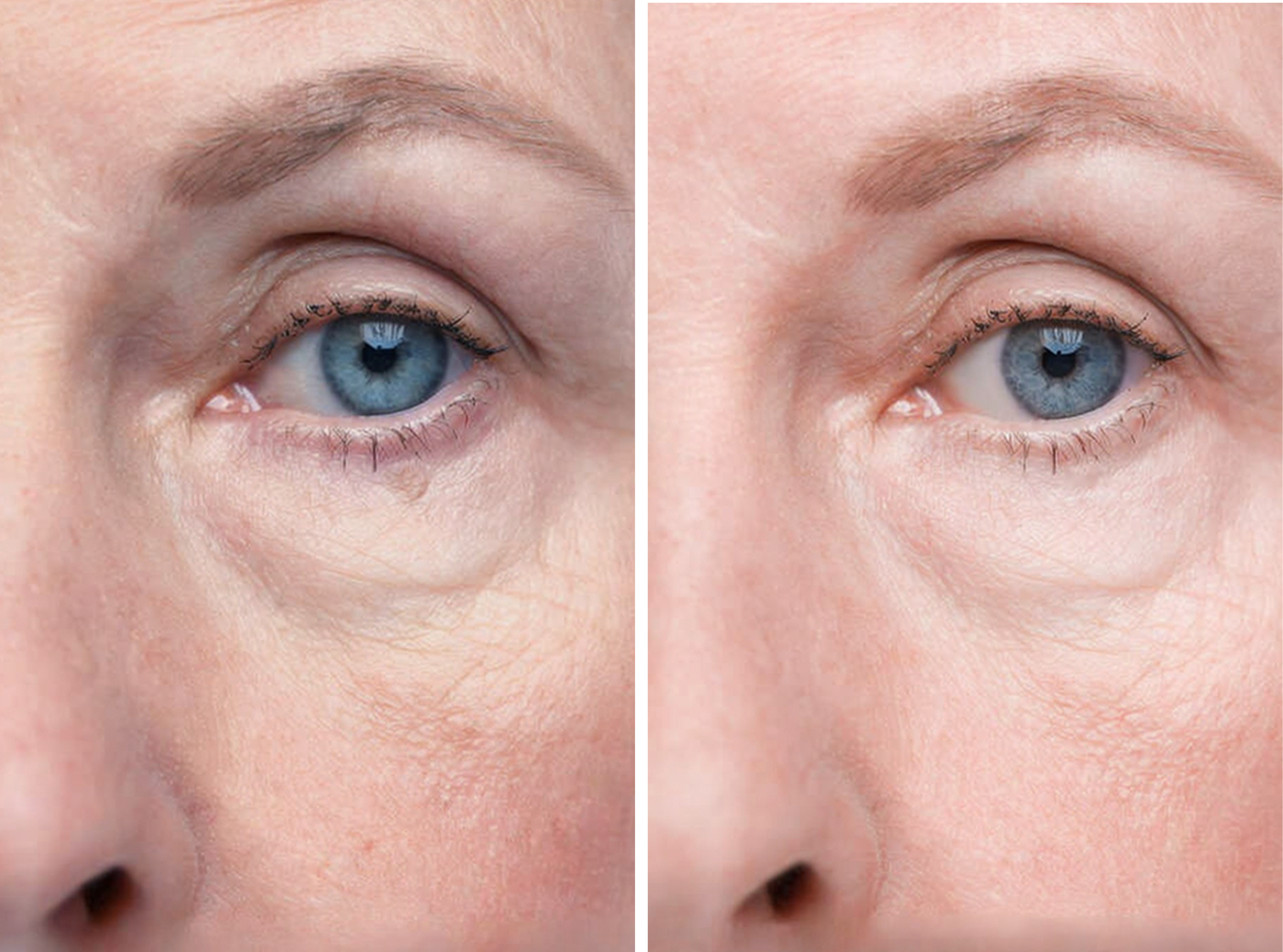 Reduce Fine Lines